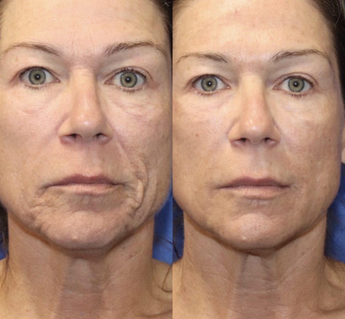 Before and After patient image after medical aesthetic treatments at Uplifted Aesthetics.